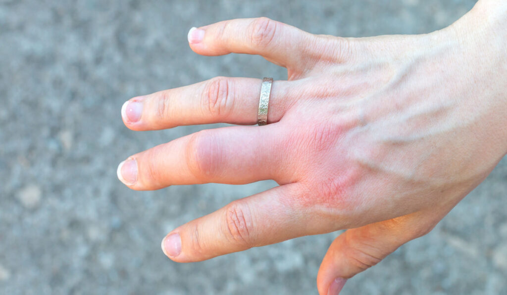 right hand swollen fingers with wedding ring